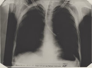 X-ray picture of an upper body